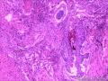 乳头状鳞状细胞癌图8