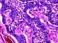 乳头状鳞状细胞癌图22