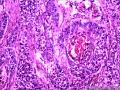 乳头状鳞状细胞癌图6
