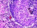 乳头状鳞状细胞癌图2