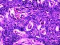 乳头状鳞状细胞癌图23