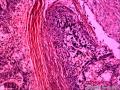 乳头状鳞状细胞癌图12