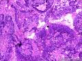 乳头状鳞状细胞癌图11