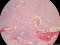 经典病例学习-梭形细胞癌（癌肉瘤）图7