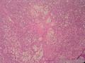 儿童腹膜后肿瘤（已确诊：胚胎性横纹肌肉瘤）图6