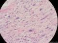 经典病例学习-梭形细胞癌（癌肉瘤）图18