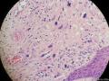 经典病例学习-梭形细胞癌（癌肉瘤）图15