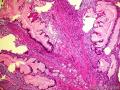 又一例胃黏膜病变, 请高诊 ( 已确诊: 胃黏膜下丛状纤维粘液瘤 )图2