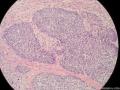 经典病例学习-梭形细胞癌（癌肉瘤）图9