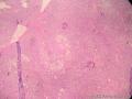 儿童腹膜后肿瘤（已确诊：胚胎性横纹肌肉瘤）图5