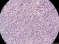 经典病例学习-梭形细胞癌（癌肉瘤）图14
