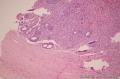 卵巢肿瘤（1）图36