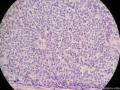 经典病例学习-梭形细胞癌（癌肉瘤）图12