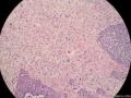 经典病例学习-梭形细胞癌（癌肉瘤）图8