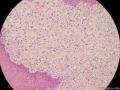 经典病例学习-梭形细胞癌（癌肉瘤）图11