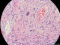 经典病例学习-梭形细胞癌（癌肉瘤）图19