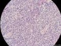 经典病例学习-梭形细胞癌（癌肉瘤）图13
