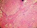 又一例胃黏膜病变, 请高诊 ( 已确诊: 胃黏膜下丛状纤维粘液瘤 )图5