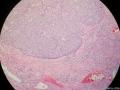 经典病例学习-梭形细胞癌（癌肉瘤）图5