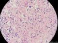 经典病例学习-梭形细胞癌（癌肉瘤）图17