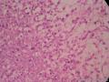 儿童腹膜后肿瘤（已确诊：胚胎性横纹肌肉瘤）图10