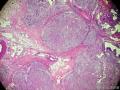 又一例胃黏膜病变, 请高诊 ( 已确诊: 胃黏膜下丛状纤维粘液瘤 )图9