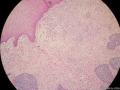 经典病例学习-梭形细胞癌（癌肉瘤）图3