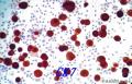 值得推荐的细胞免疫组化制片方法--液基薄层制片！图12
