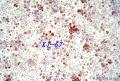 值得推荐的细胞免疫组化制片方法--液基薄层制片！图19
