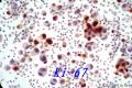 值得推荐的细胞免疫组化制片方法--液基薄层制片！图20
