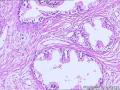 前列腺 上皮细胞空泡化有问题吗 尿道上皮可报腺性尿道炎？图6