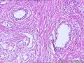 前列腺 上皮细胞空泡化有问题吗 尿道上皮可报腺性尿道炎？图7