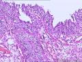 前列腺 上皮细胞空泡化有问题吗 尿道上皮可报腺性尿道炎？图3