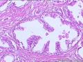 前列腺 上皮细胞空泡化有问题吗 尿道上皮可报腺性尿道炎？图5