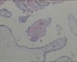 水肿性流产？部分性水泡状胎块？再加几张图片图5