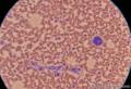 骨髓 巨大细胞是什么呀，反应性还是转移癌？图24