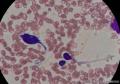 骨髓 巨大细胞是什么呀，反应性还是转移癌？图29
