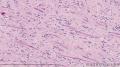 阴道壁肿块-上海市骨与软组织肿瘤读片2013（2-4）宁波临床病理诊断中心提供图5
