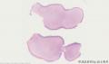 阴道壁肿块-上海市骨与软组织肿瘤读片2013（2-4）宁波临床病理诊断中心提供图1