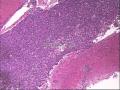 脾占位-上海市骨与软组织肿瘤读片2013（2-3）上海交大附属瑞金医院提供图5