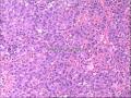 脾占位-上海市骨与软组织肿瘤读片2013（2-3）上海交大附属瑞金医院提供图9
