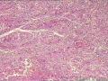 肾盂积水伴肾鳞状细胞癌图11