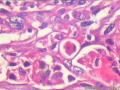 肾盂积水伴肾鳞状细胞癌图2