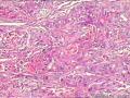 肾盂积水伴肾鳞状细胞癌图8
