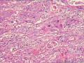 肾盂积水伴肾鳞状细胞癌图9
