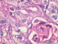 肾盂积水伴肾鳞状细胞癌图14
