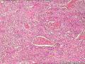 肾盂积水伴肾鳞状细胞癌图6