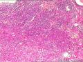 肾盂积水伴肾鳞状细胞癌图5