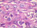 肾盂积水伴肾鳞状细胞癌图1