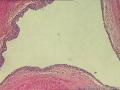 肾盂积水伴肾鳞状细胞癌图3